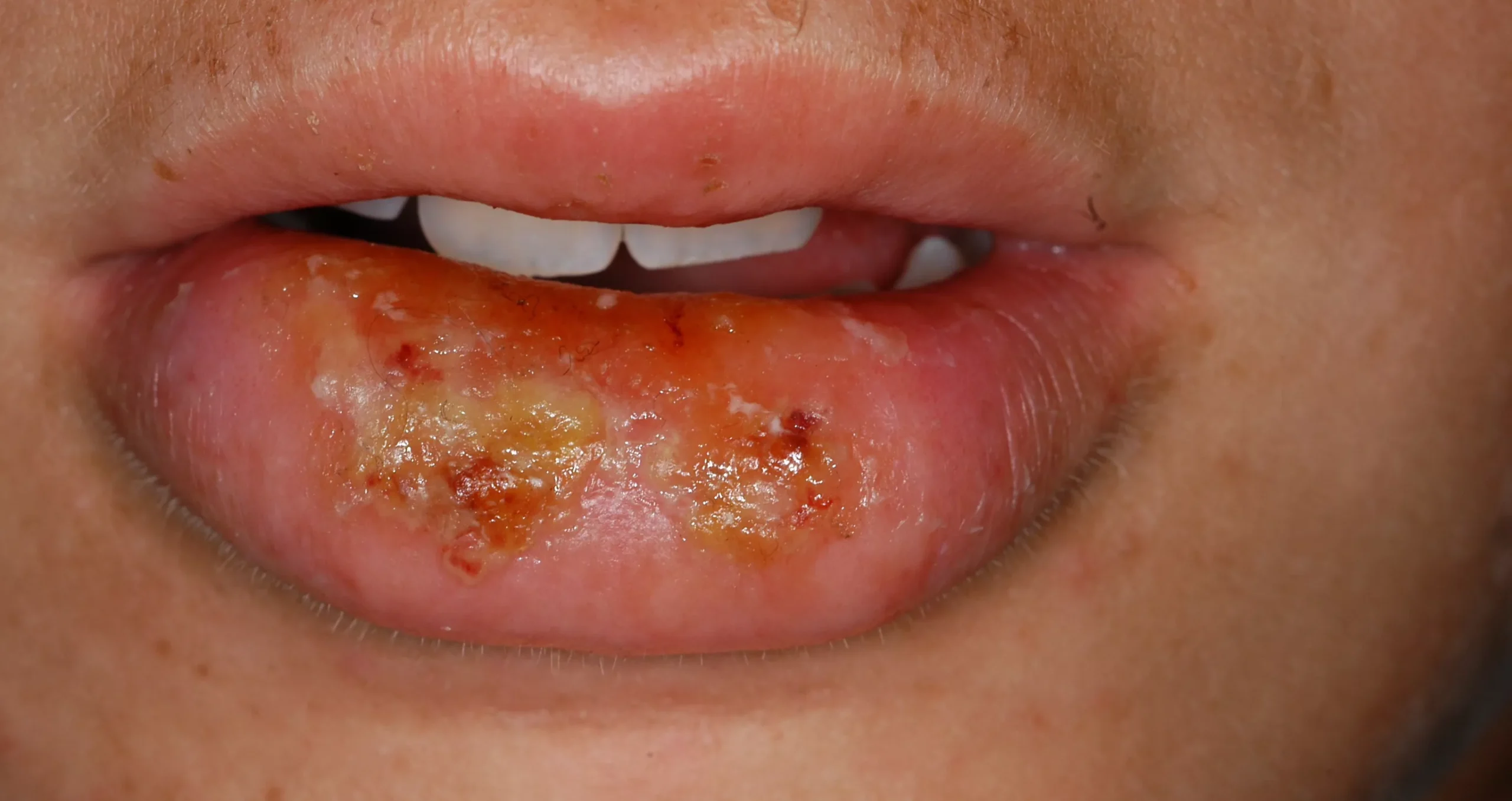 Newport Beach Dentistry Laser Dentistry before