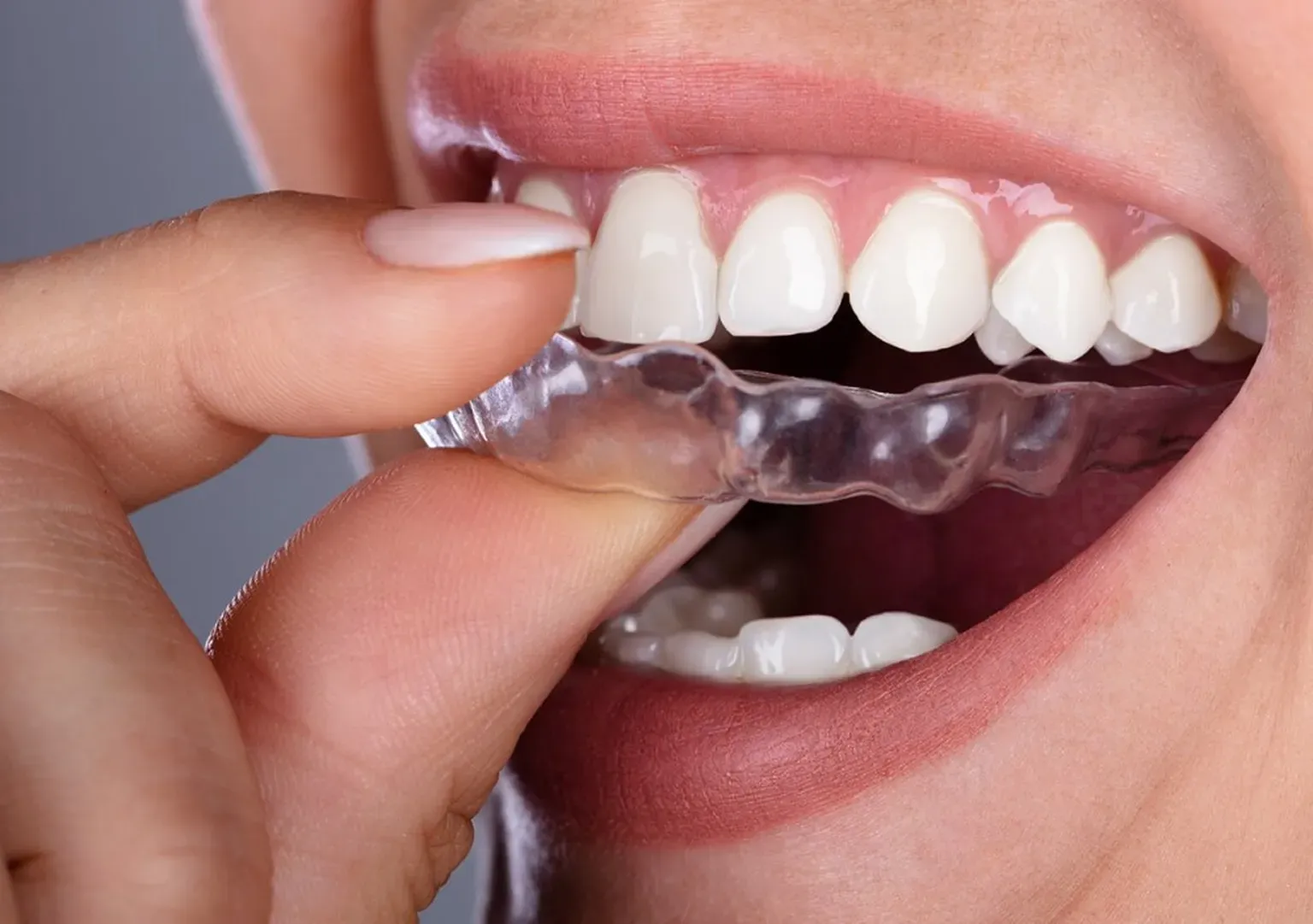 Newport Beach Dentist Invisalign
