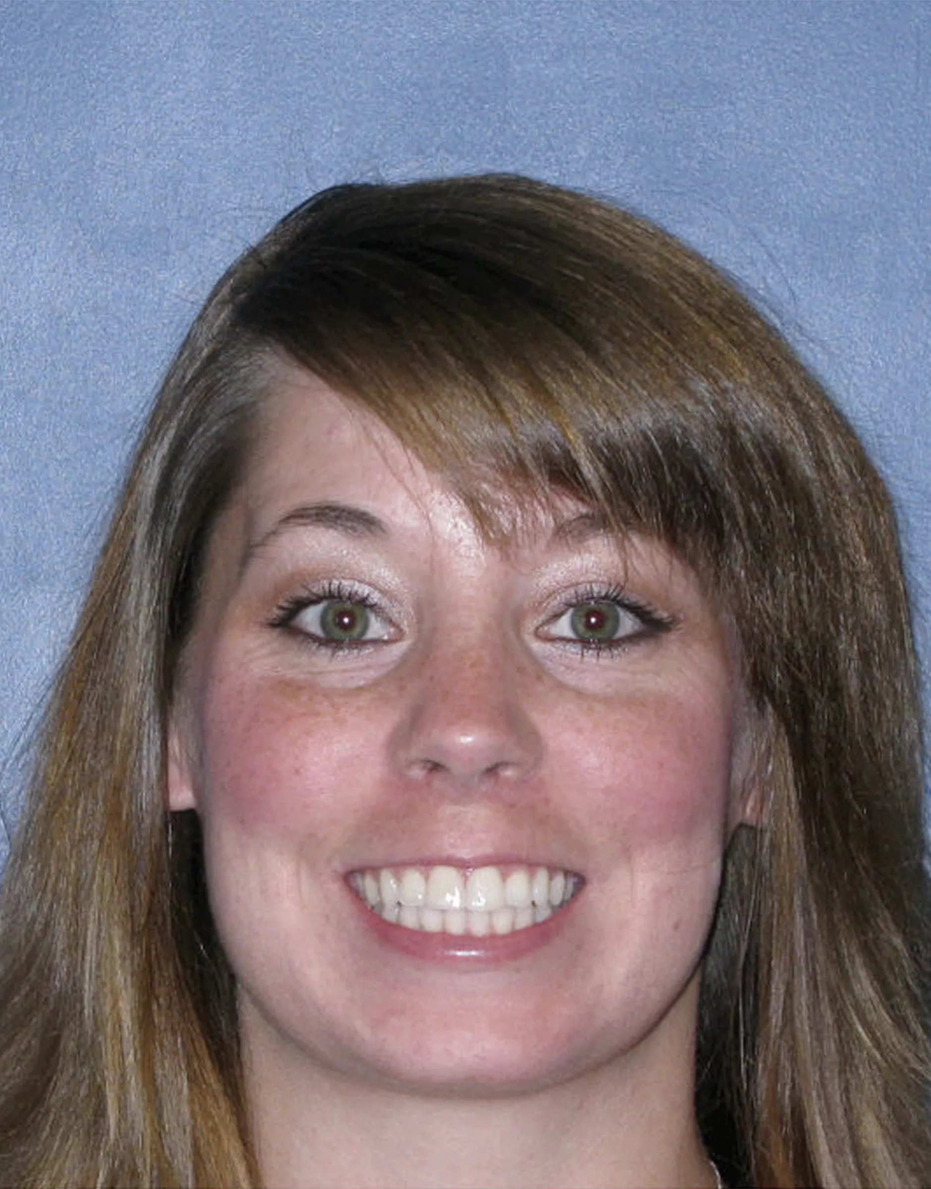 Invisalign Magic: Secrets to Perfect Teeth!