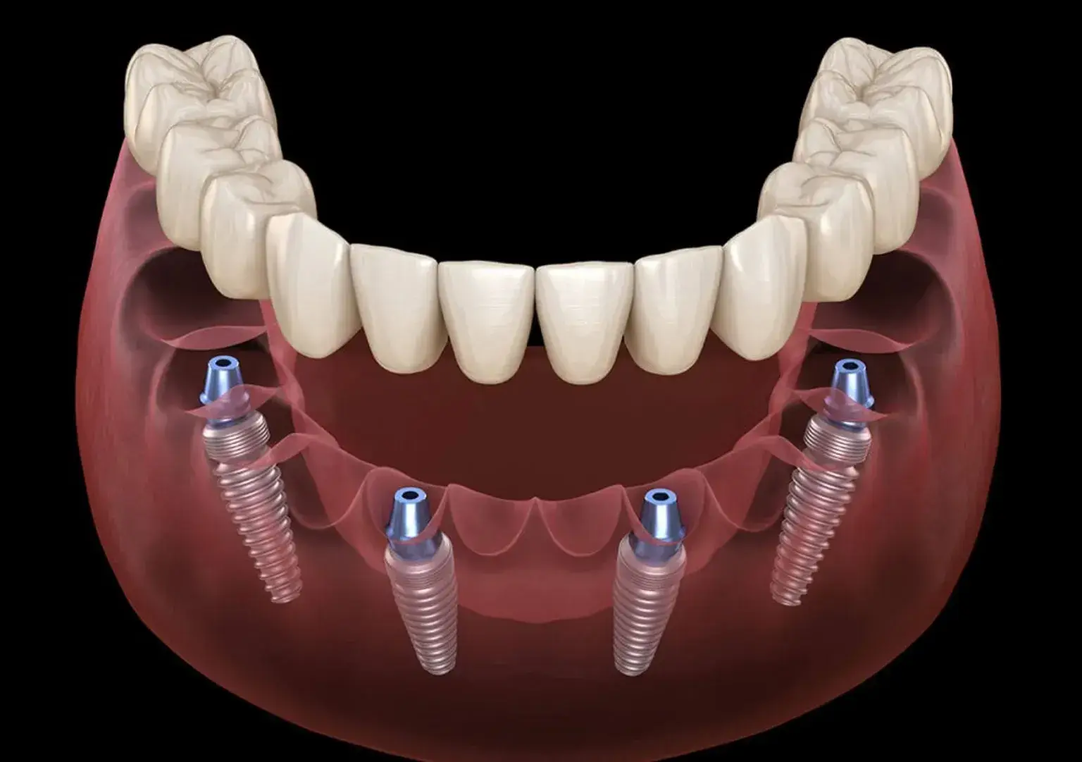 The Benefits Of Implant-supported Dentures When Replacing Missing Teeth