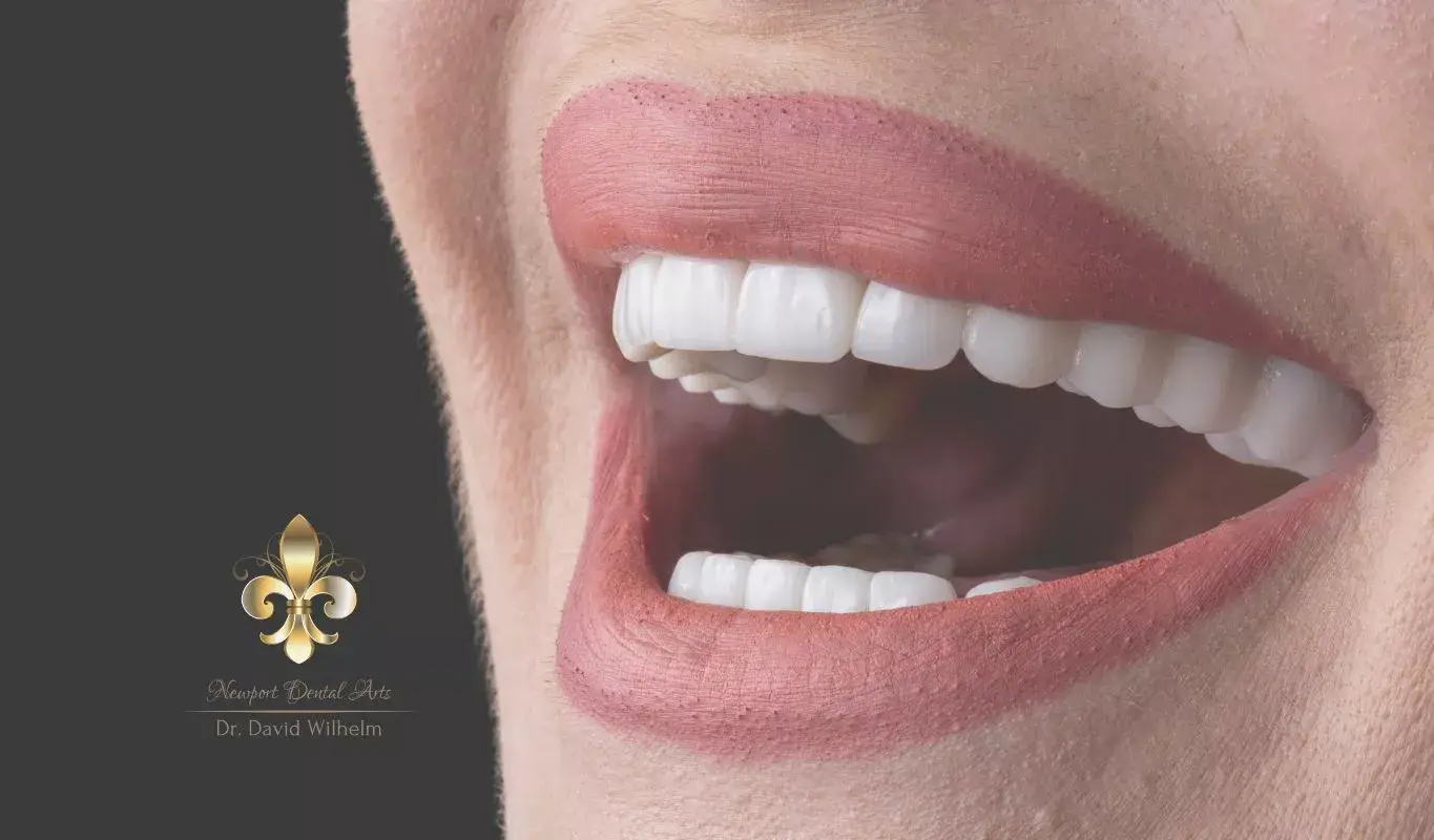 7 Top Advantages of Choosing Porcelain Veneers