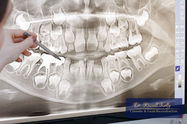 CAD_CAM crown design or AI-enhanced scan used in digital dentistry in Orange, CA
